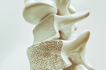 PRP Clinic in San Antonio TX specialized in PRP Therapy for Osteoporosis 